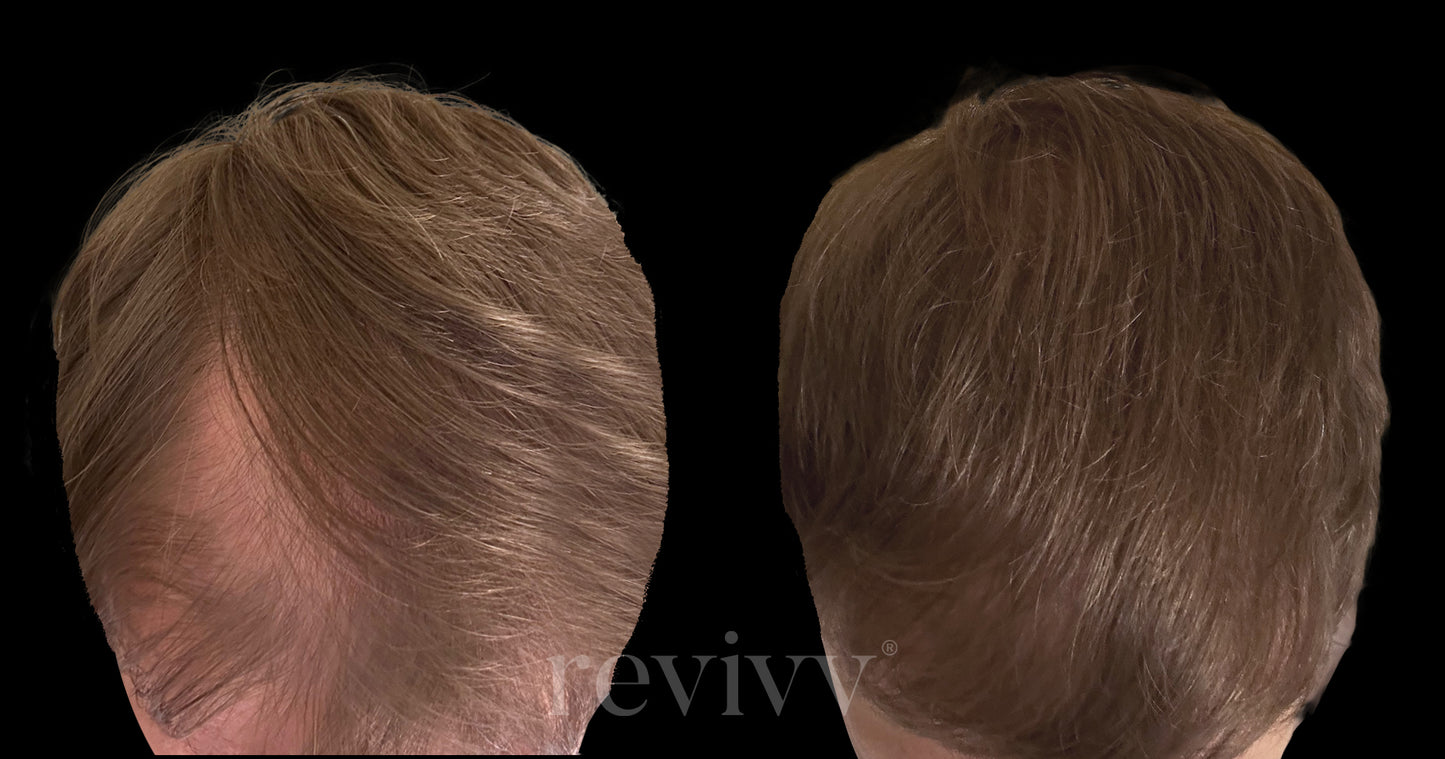 Revivv For Him Hair Growth Serum